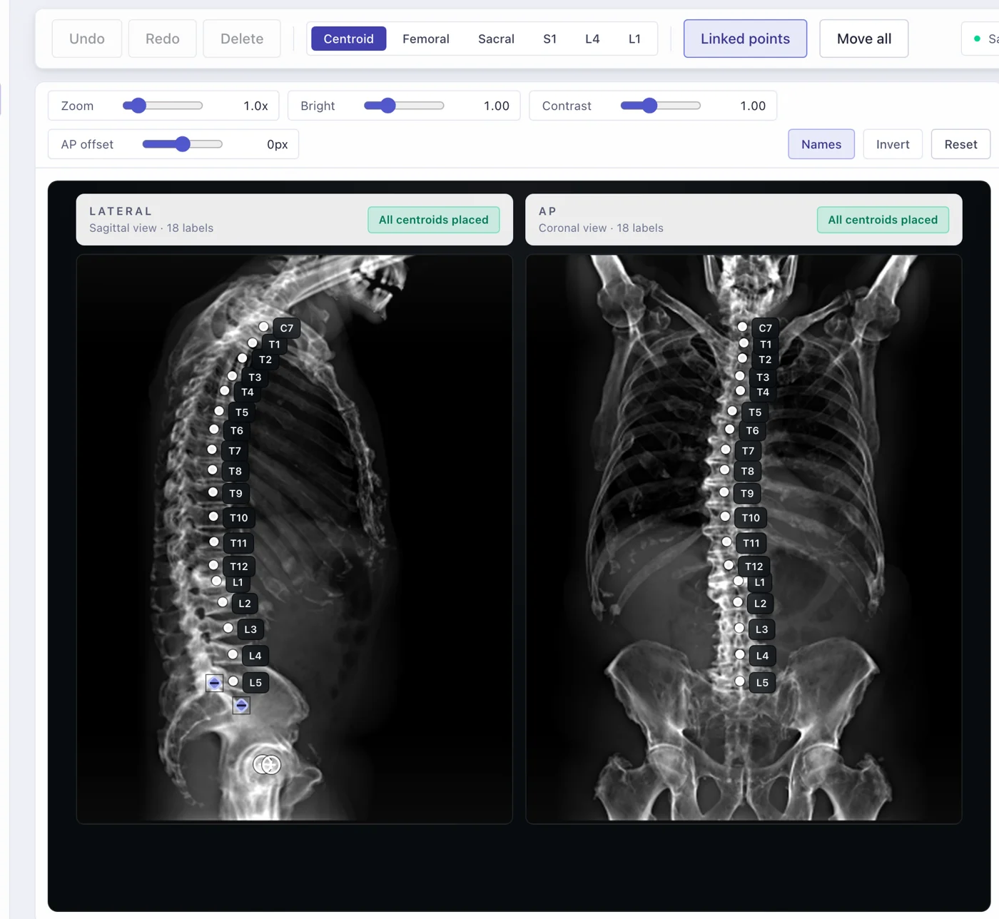 SpineIQ landmarking view: lateral and frontal radiographs with vertebral centroids labelled from C7 to L5