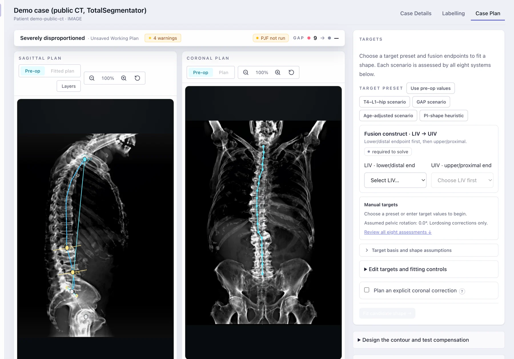 SpineIQ plan workspace: sagittal and coronal plan views over the radiographs, with target presets and the fusion construct picker